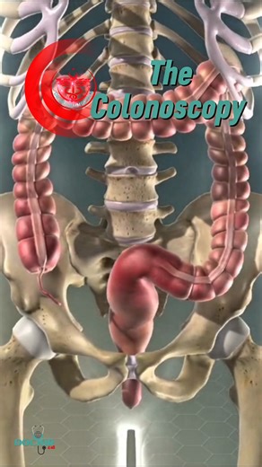 The Procedure for Colonoscopy #colonoscopy #procedure #colon #fblifestyle | Dr. Muhammed Ziya