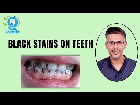 Understanding and Treating Black Stains on Teeth: Expert Advice.