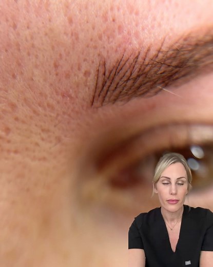 Ladies of Essex & surrounding areas, imagine waking up with perfect brows every single day, minimal maintenance, just flawless brows 24/7 ✨ Semi-permanent brows are perfect if you're looking for a fuller/thicker, more defined brow that enhances your natural beauty 💖 Natural looking results, tailored uniquely to you! ⭐ Long-lasting results (2-3 years on average)🤍 Perfect brows 24/7 ✅ Age-appropriate and bespoke treatments ✨ Free consultation and advice upon enquiry 🤍 Click ‘Learn More’ to enqu