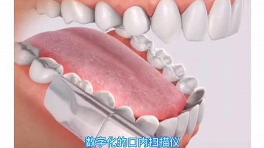 口腔黑科技3D数字化口腔扫描，快速获取口内模型