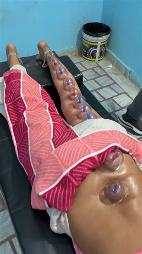 L4-L5 Disc Bulge Treatment with Cupping Therapy | Lower Back Pain Relief