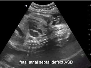 case 421 fetal atrial septal defect ASD