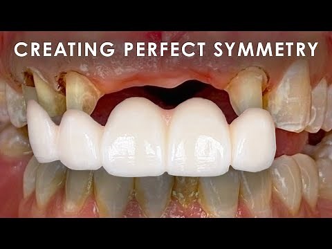 Creating Perfect Symmetry for Zirconia Bridges