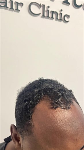 🌿Hair Thinning & Hair Loss Journey Tallaabo toddobaadle ah oo timahaaga dib u dhiseysa!☘️ 💡LLLT Laser Therapy - Dib u kicinta xididdada timaha & korriin cusub GFC PRP Treatment - Daryeel qoto dheer oo kiciyo timaha hurda Scalp Spray - Nafaqo si toos ah u gaarta xididka timaha Hair Products - 🧴Shampoo, mask & tonic si joogto ah u adkeeya timaha * Weekly Program Waxaad arkeysaa isbedel muuqda 3-4 toddobaad gudahood Timaha oo yara daata & korriin cusub oo bilowda • Lunavita Hair Clinic - Taleh, 