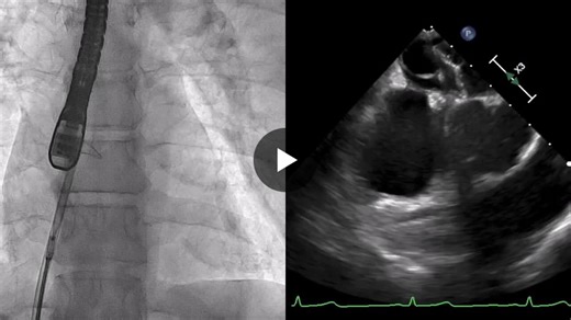 In 2025 PFO/ASD cases in our CathLab increased by 23% with a total of 83 successful closures. This is a big accomplishment for me as PFO/ASD program is something I really care about aiming to offer… | Alessandro Maolo