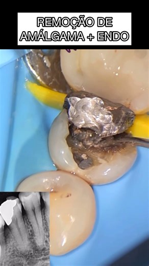 OLHA SÓ OQUE DEU ESSA REMOÇÃO DE AMÁLGAMA#amalgama#restauracao#resina#dentista#dentistry#odontologia