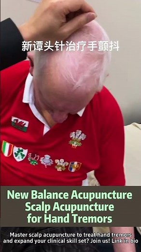 New Balance Acupuncture - Scalp Acupuncture for Hand Tremor