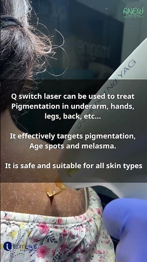 Q-Switch Laser