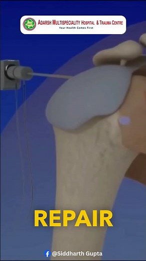 Shoulder Arthroscopy Made Simple Explained Procedure Benefits and Recovery | #shoulder #painrelief