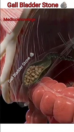 Gallbladder Stone 3d Animation #medical #3d #science #facts #gallbladder