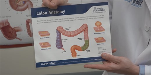 Why screening for colorectal cancer matters