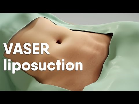VASER liposuction is also called ultrasound-assisted liposuction, VASER lipo or LipoSculpting