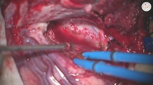 Temporal Lobectomy and Amygdalohippocampectomy | Cases | The Neurosurgical Atlas