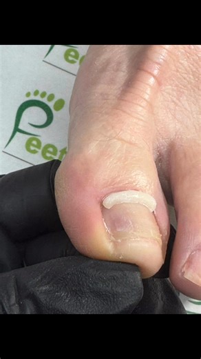 Let Onyfix fix it…. Non invasive toenail correction. There is a remedy and relief for your painful toenails. | FeetMatters MediNail Spa