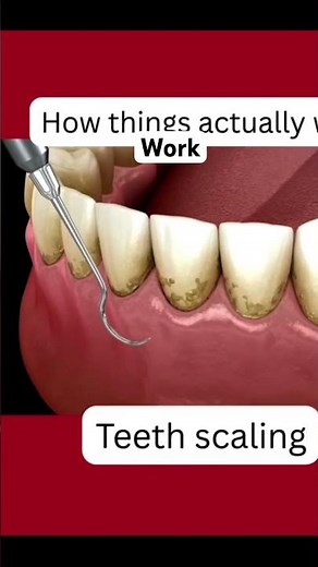 How scaling work #dentist #dental #dentalhealth #awareness #scaling #teeth