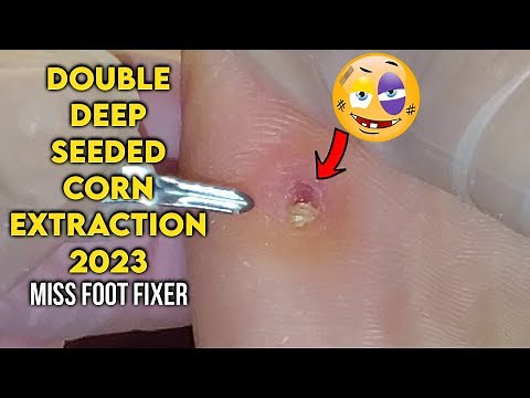 EXTRACTION OF DOUBLE DEEP SEED CORN ON SOLE OF FEET 2023 BY FAMOUS PODIATRIST MISS FOOT FIXER