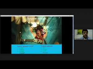 Three and Four Level ACDF How I Do it