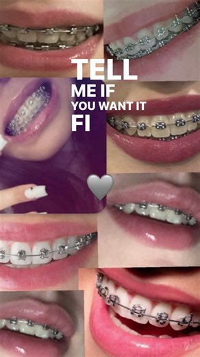 Team Grey Braces Showcase: Unique Styles and Tips