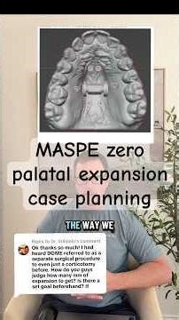 MASPE zero palatal expansion case planning #maspezero #maspe #marpe #palatalexpansion