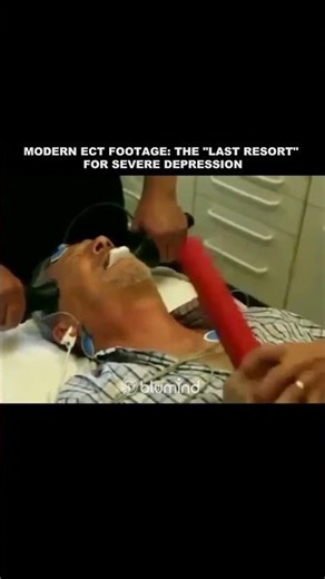 What Actually Happens During ECT? (Real Footage)