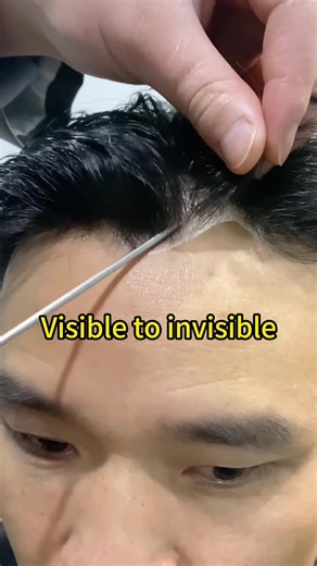 Transform Your Look with Non-Surgical Hair Replacement Solutions
