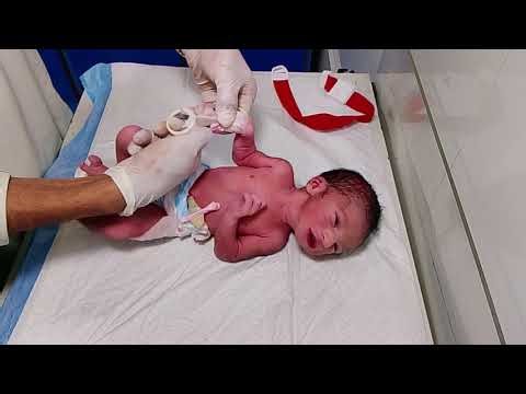 Preterm baby admitted to NICU – IV cannula passed & first injection given