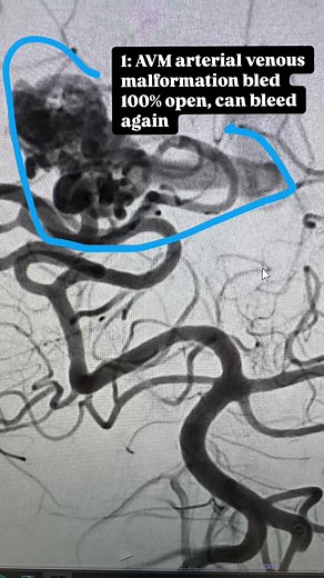 Ruptured AVM Embolization: A Case of the Week