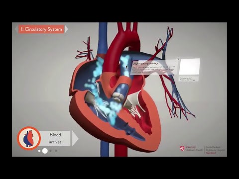 Repairing the Heart: Unifocalization - Stanford Children's Health