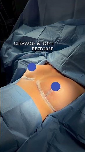 Breast reduction isn’t about simply going smaller #breastreduction