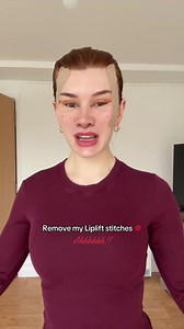 Take my Liplift stitches out with me ahhhh!💋 I COULD CRY!! #antoniahigham #faceliftvlog #liplift #lipliftvlog #midfacelift