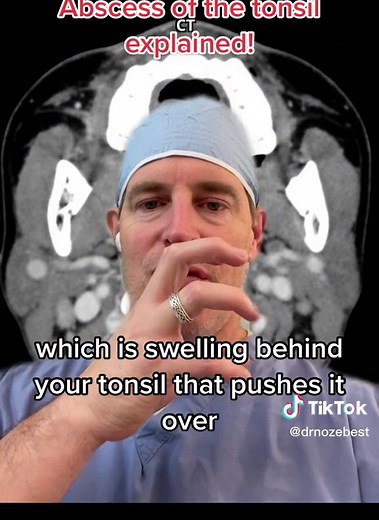 #greenscreen this CT scan shows exactly why it hurts so much when you have an abscess around your tonsil. You can see how all that pus is pushing the tonsil tissue over and blocking off your airway as well as touching your uvula. Once we put a needle in there to drain it all the swelling goes away and you feel better. #Tonsil #TonsilStone #Abscess #TonsilStoneRemoval #trismus #Pain #Fever #Pediatrics #ENT #Surgery #Swallow #Swallowing #Miserable #FYP #ForYou #Surgery