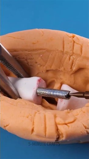 Hammertoe Correction Surgery: Before & After 👣