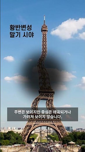 황반변성 환자가 보는 세상은? | 황반변성 환자는 이렇게 보입니다 | 안과 질환 시뮬레이션 영상 |