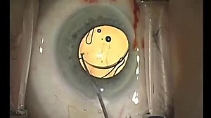 Rayner Sulcoflex Implantation - Eyetube