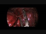 Situs Inversus Uniportal Thoracoscopic Left Middle Lobectomy  • Video • MEDtube.net