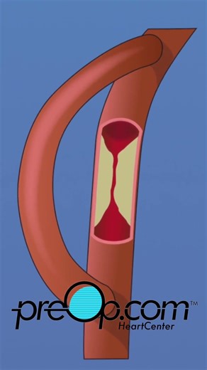 🔍 PreOp® Coronary Artery Bypass Graft (CABG) On Pump 💡 ICU & Early Recovery