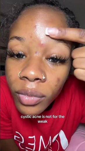Dealing with painful underground pimples? Here's what you need to know