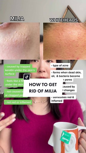 How to Get Rid of Milia: 3 Effective Ways You Need to Try