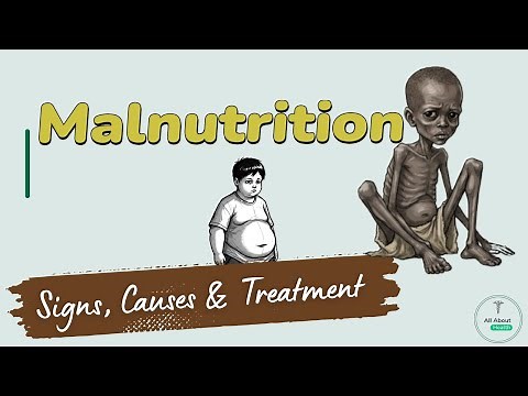 Malnutrition – Signs, Causes & Treatment You MUST Know Hidden Health Risks