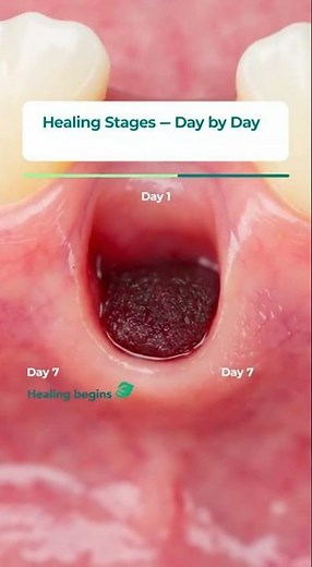 🦷 Tooth Extraction Healing Stages: What’s Normal to See