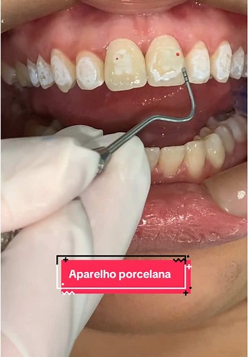 Aparelho de Porcelana: Montagem e Explicação Completa