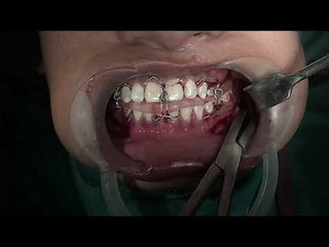 Open correction by surgery first technique with mandibular Osteotomy Surgery - Dr. Sunil Richardson