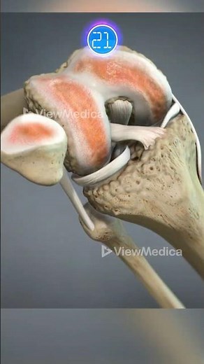 Total Knee Replacement Surgery (3D Animation)