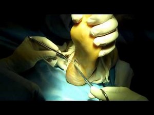 Plantar Fasciotomy