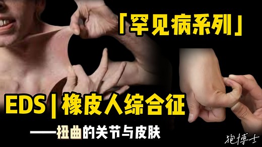 「罕见病系列」关节松脱的橡皮人综合征，刘开心患的是什么病？认识 EDS（Ehlers-Danlos syndrom）