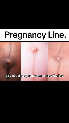 Understanding Linea Nigra: The Pregnancy Line Explained