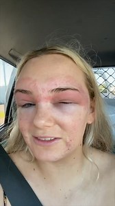 1.6M views · 3.9K reactions | Oh no! This bride had an allergic reaction - just one day before her wedding. | News.com.au Lifestyle | Facebook