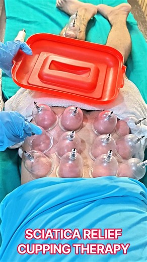 Sciatica Back Pain Cupping Therapy Treatment Lower Back & Leg Pain Relief #painrelief #physiotherapy