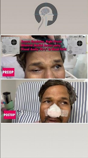 Recovery after pituitary surgery| Pituitary Adenoma| Dr Anil Kothiwala