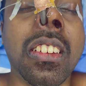 Facial asymmetry correction and chin augmentation